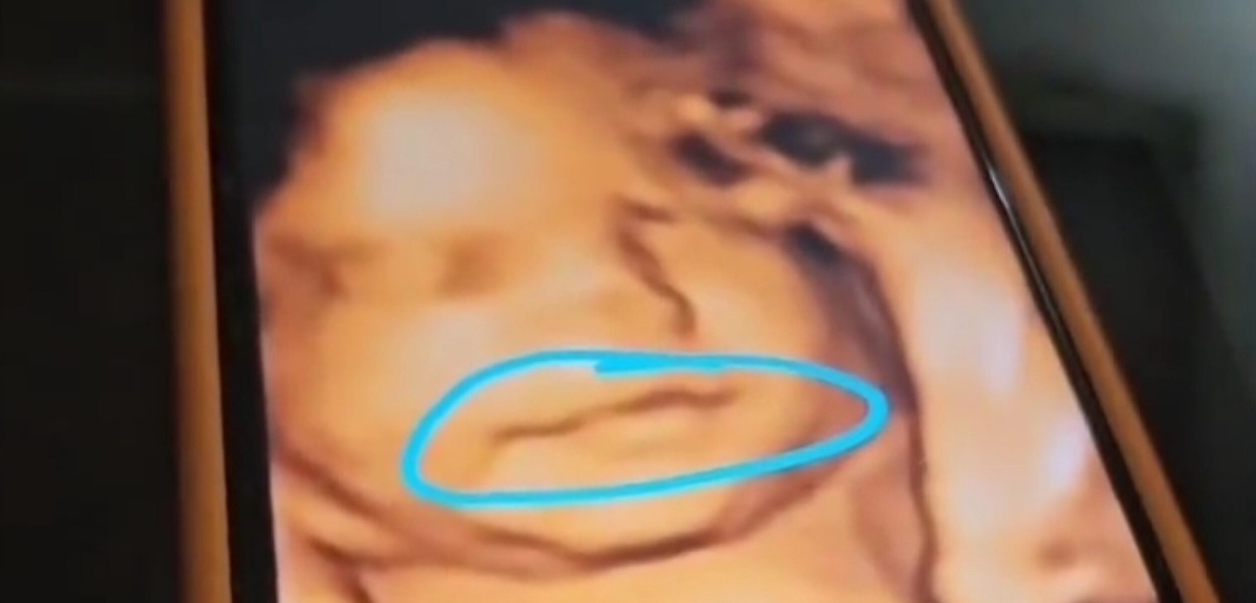 Geger! Janin 9 Bulan Tiba-Tiba Hilang, Dokter Kandungan Ungkap Kejadian Misterius