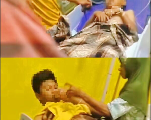 Petasan Kaleng Susu Meledak, 2 Korban Luka Bakar